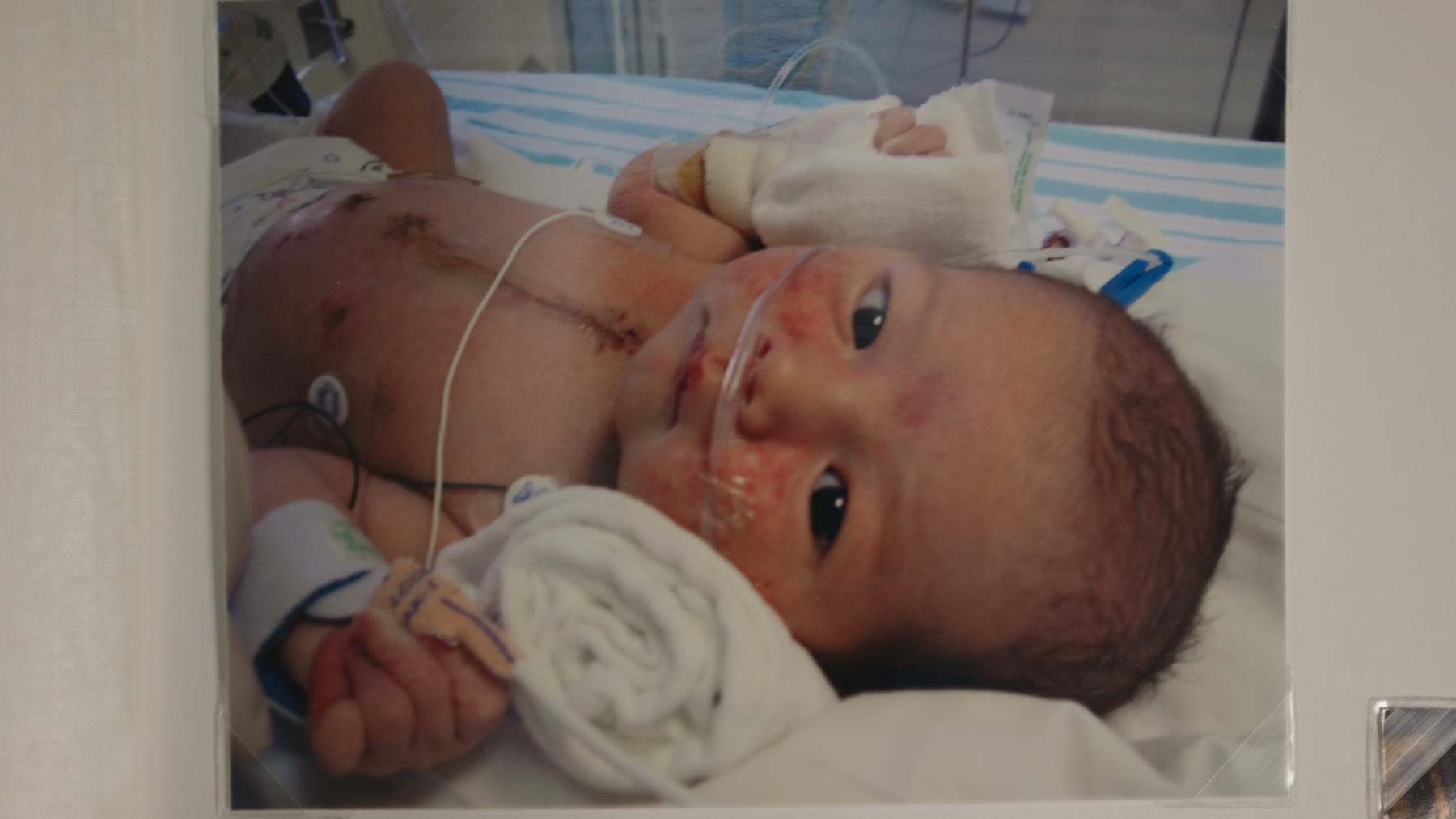 A newborn in a hospital incubator, a healed surgical scar down the centre of the chest, monitoring leads on the skin.