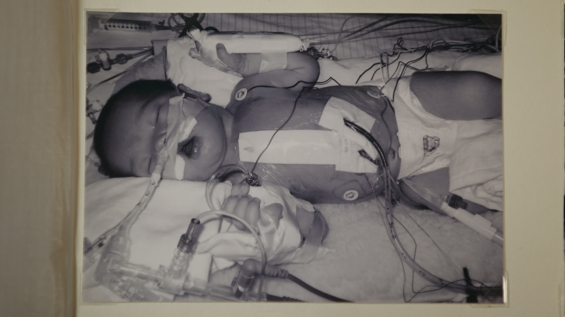 An archival black-and-white photograph of the infant in intensive care, connected to a ventilator and monitoring lines.